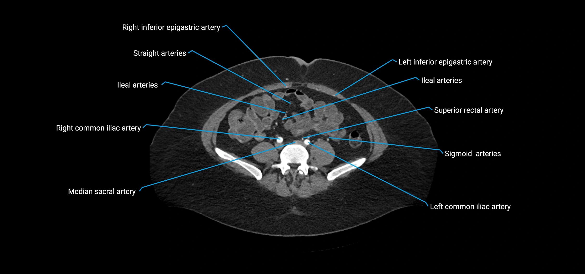 CTA abdomen axial cross sectional anatomy labelled image_158 (2).webp